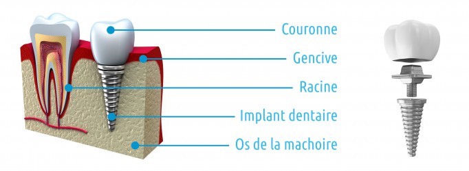 implantologie-dentaire-sch